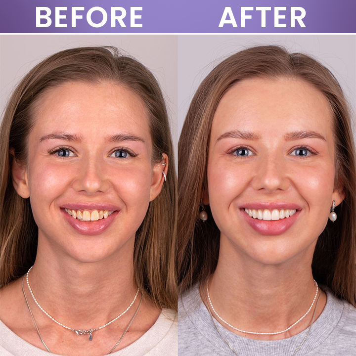 LIMETOW® Instant Teeth Whitening Stick