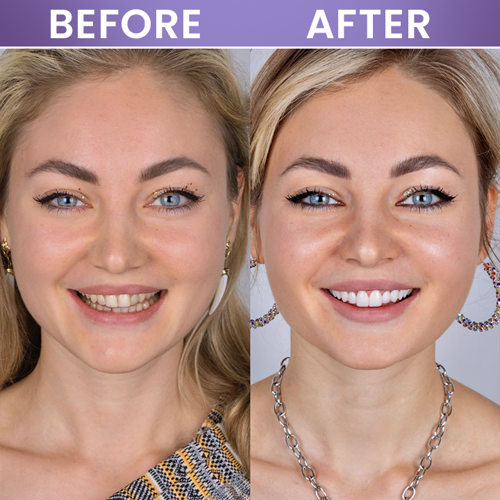 LIMETOW® Instant Teeth Whitening Stick