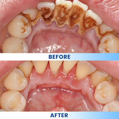 LIMETOW®  Teeth Brightening Essence