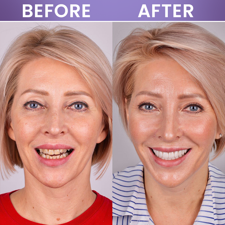 LIMETOW® Instant Teeth Whitening Stick