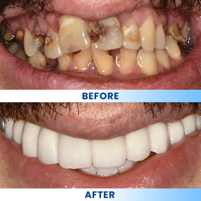 LIMETOW®  Teeth Brightening Essence