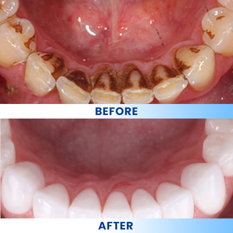 LIMETOW®  Teeth Brightening Essence