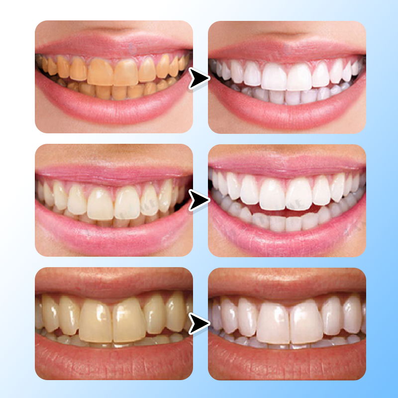 LIMETOW®  Teeth Brightening Essence