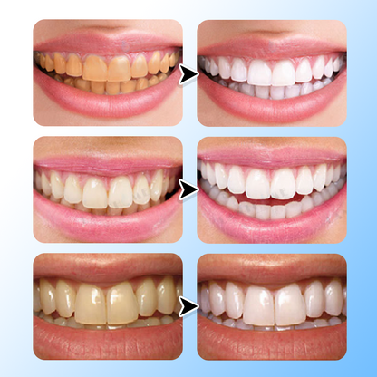 LIMETOW®  Teeth Brightening Essence