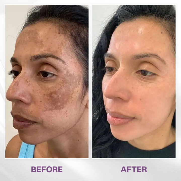 LIMETOW® Spot Refiner
