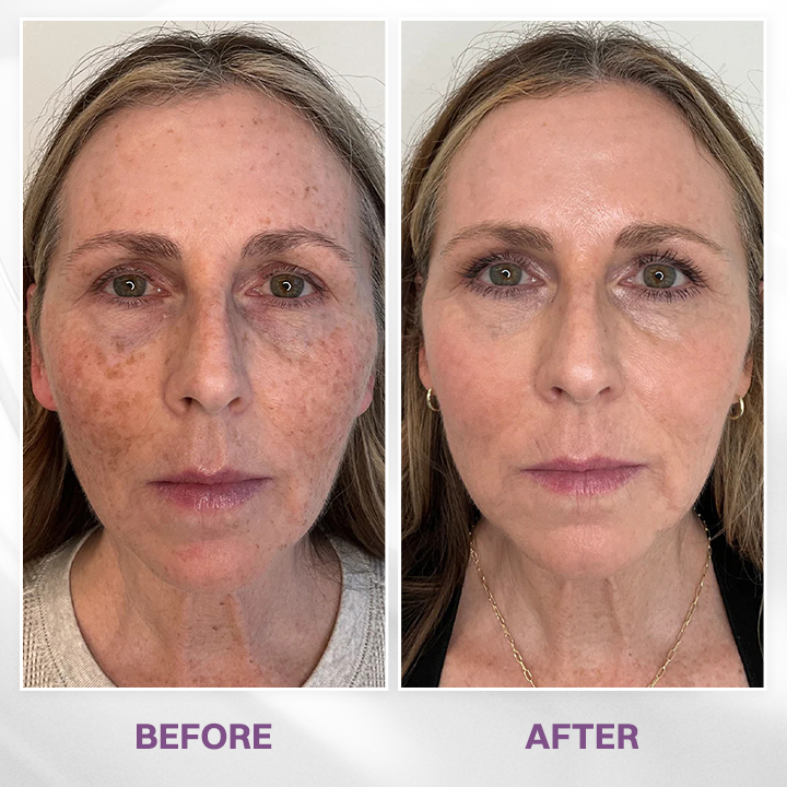 LIMETOW® Spot Refiner