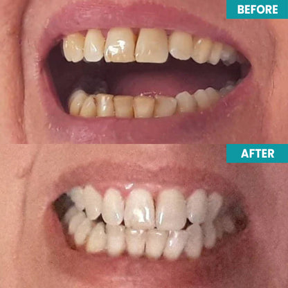 LIMETOW™ Instant Teeth Whitening Paint