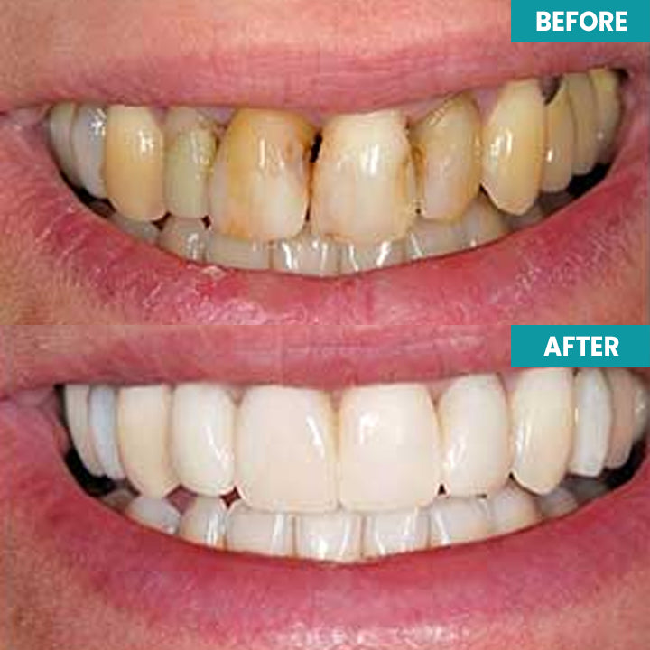 LIMETOW™ Instant Teeth Whitening Paint