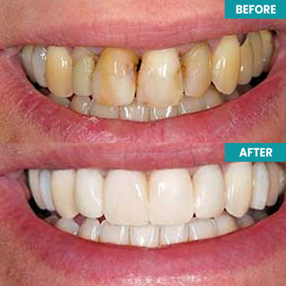 LIMETOW™ Instant Teeth Whitening Paint