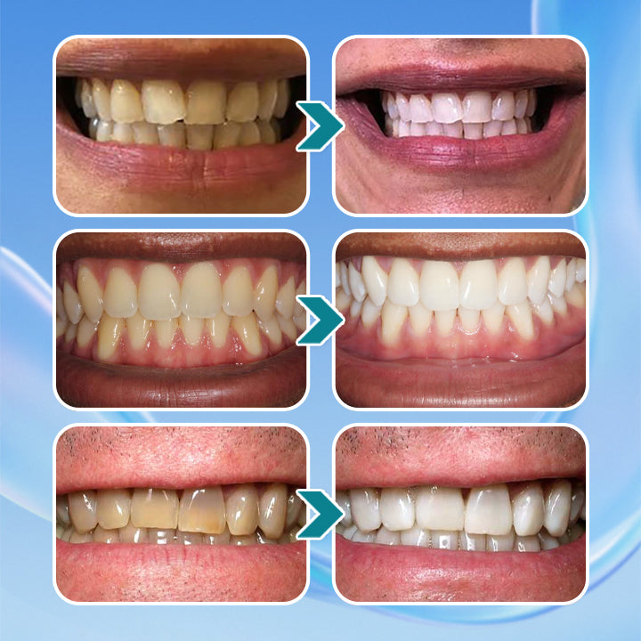 LIMETOW® Instant Teeth Whitening Paint