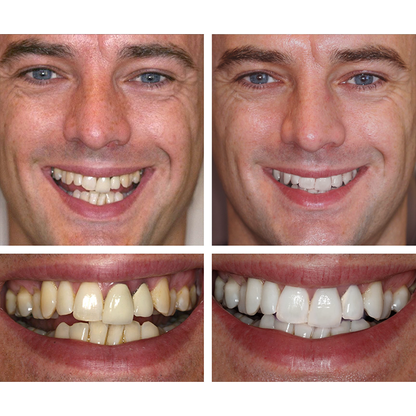 LIMETOW™ 🔥Teeth Whitening Essence🔥