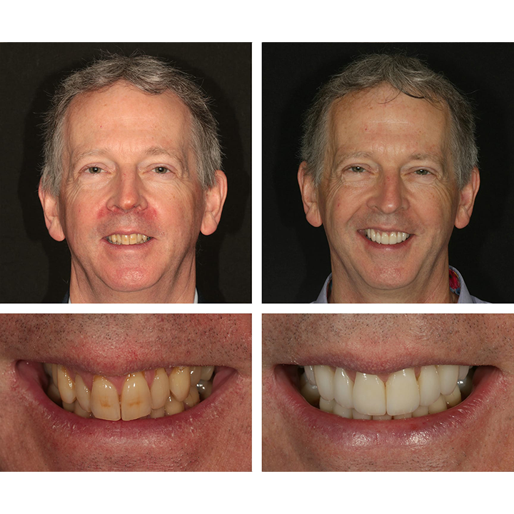 LIMETOW™ 🔥Teeth Whitening Essence🔥