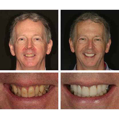 LIMETOW™ 🔥Teeth Whitening Essence🔥