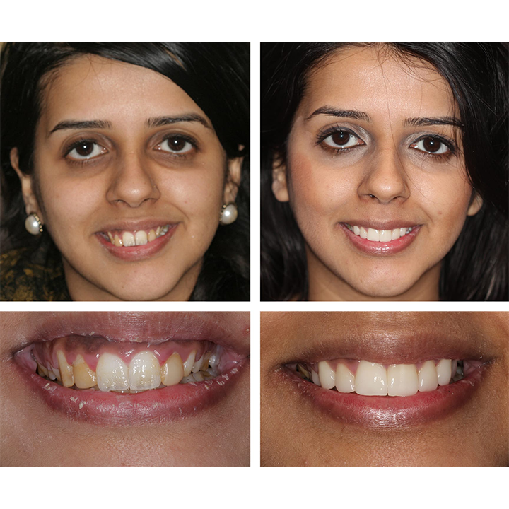 LIMETOW™ 🔥Teeth Whitening Essence🔥